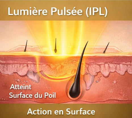 lumière pulsée IPL action surface